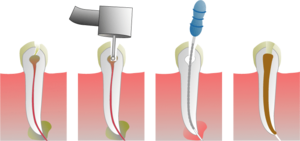 endodoncja-leczenie-kanalowe