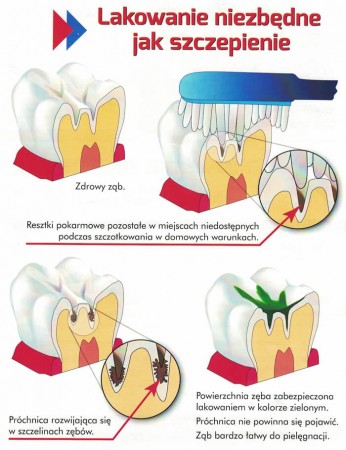 lakowanie zębów